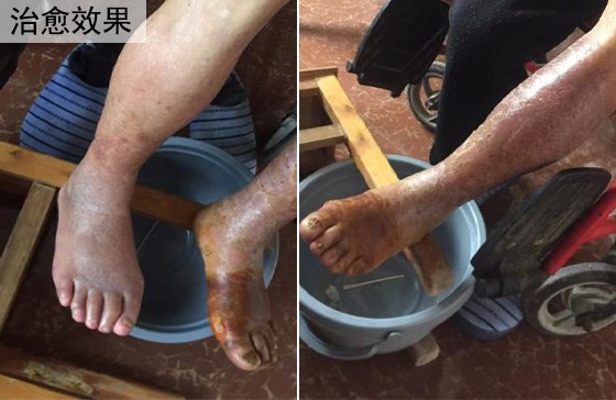 脉管炎治愈效果