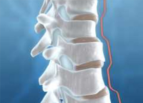 如何预防脊椎骨质增生？
