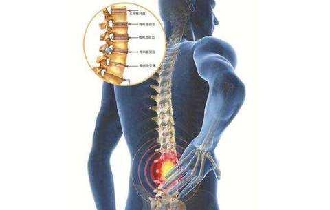 腰间盘突出治疗