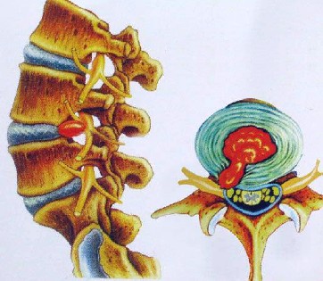 腰间盘突出腰疼难忍？试试这几招