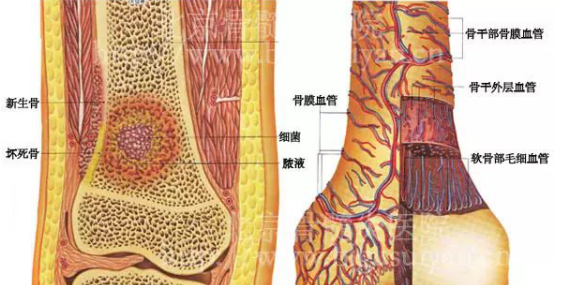 让人苦不堪言的炎症——骨髓炎