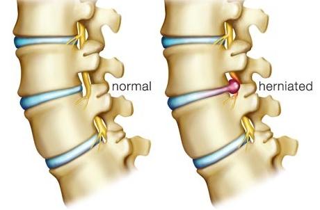 骨病医疗中心为你介绍腰间盘突出的症状表现