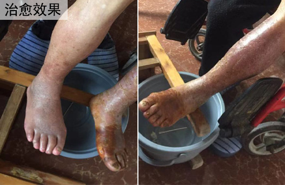 脉管炎治愈效果