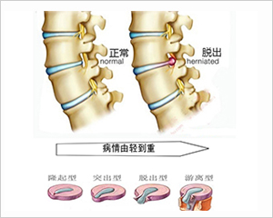 椎间盘突出