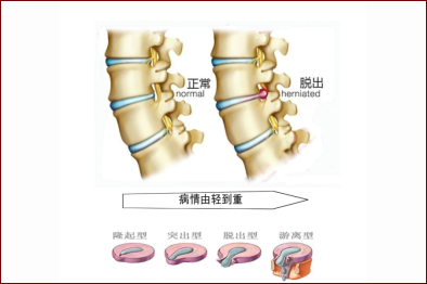 腰椎病