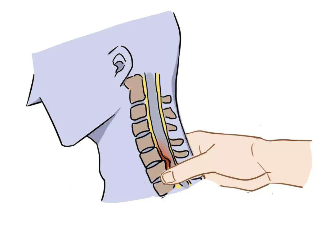 颈椎间盘突出