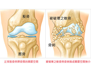 膝关节炎