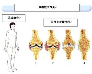 关节炎