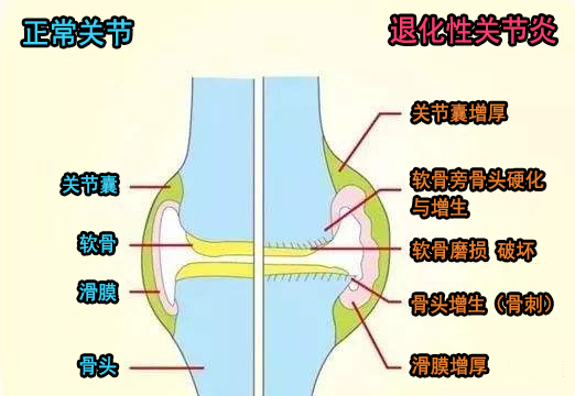 退化性关节炎