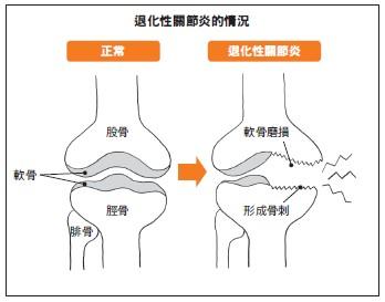 退化性关节炎