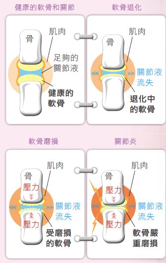 退化性关节炎