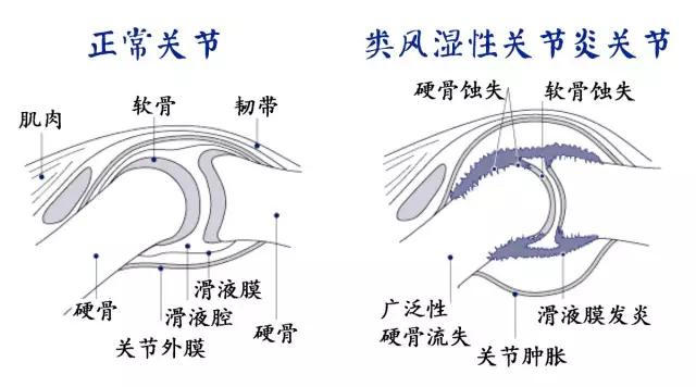 类风湿性关节炎