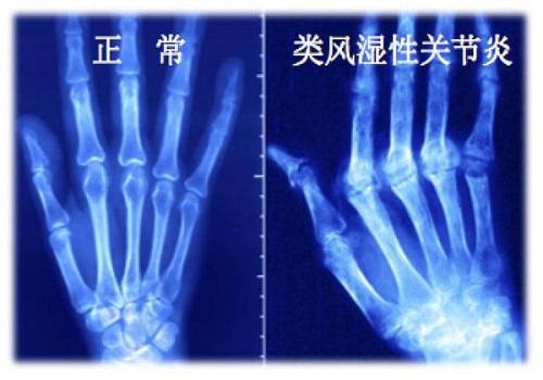 类风湿性关节炎3 类风湿性关节炎3
