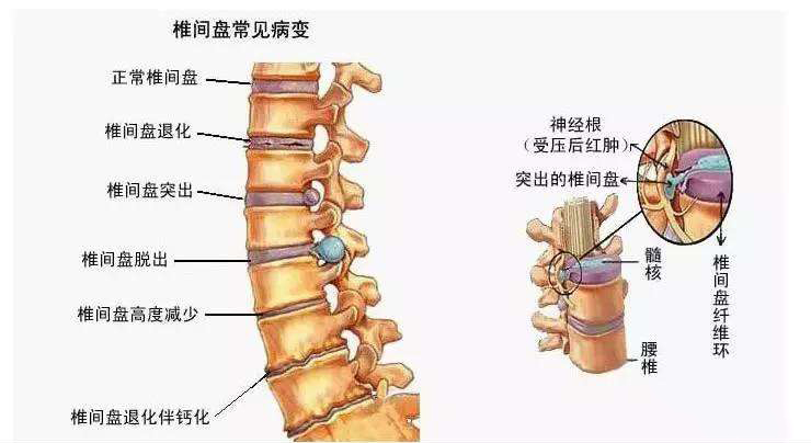 颈椎间盘突出