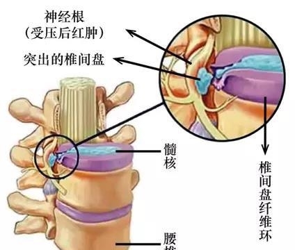 椎间盘突出